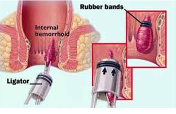 surgery for vaginal skin tags and hemmorrhoids