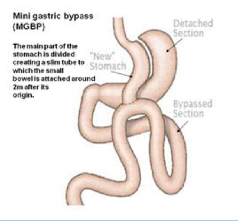 Mini Gastric Bypass Surgery Brisbane Omega Loop Gastric Bypass 