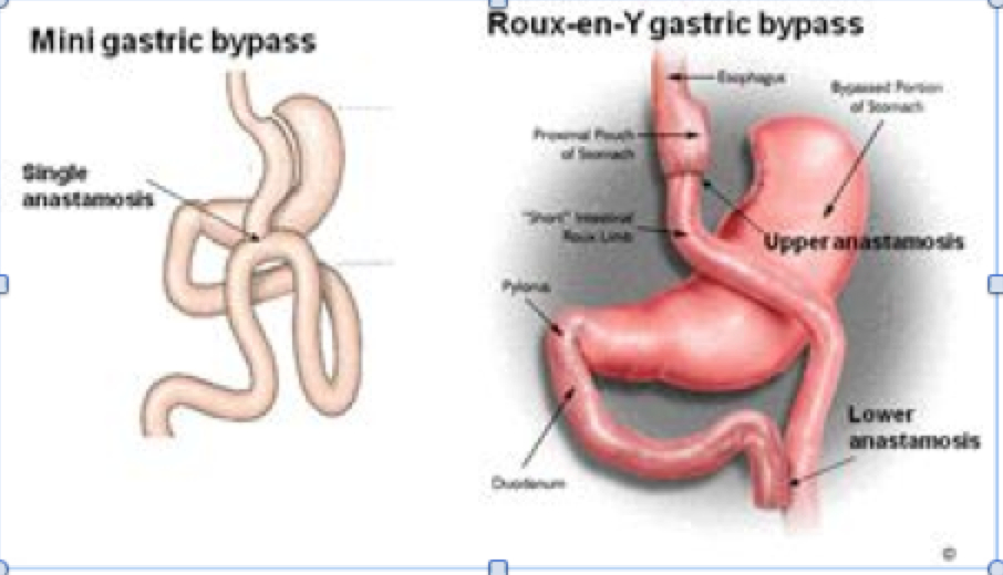 Omega Loop Gastric Bypass Mini Lap Surgery Brisbane 