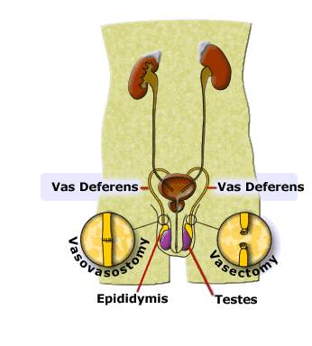 Vasectomy - Vasectomy