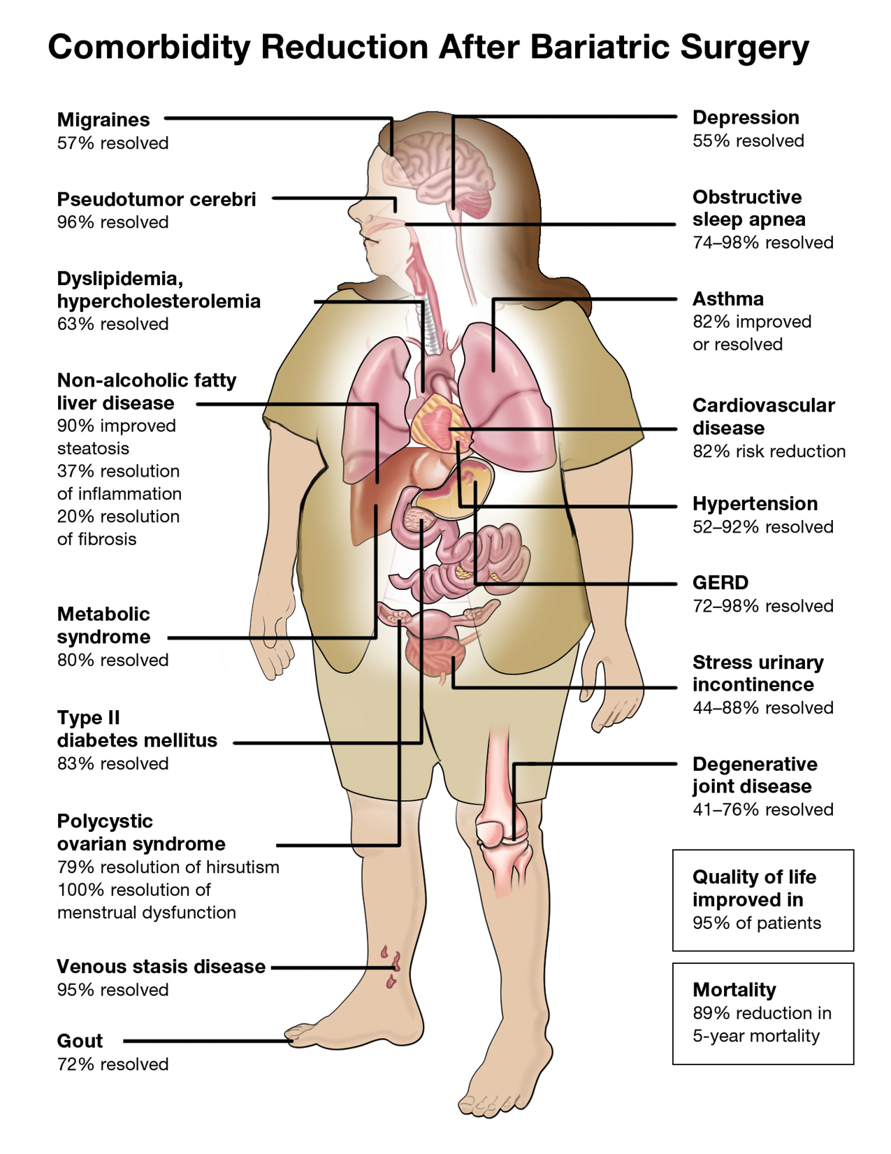 Co Morbidity illust - Comorbidity Reduction After Bariatric Surgery