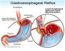 Gastro Oesophageal Reflux Disease - Gastro-Oesophageal Reflux Disease (GORD)