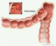 Polyps-of-theColon-and-Rectum1