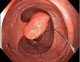 Polyps of theColon and Rectum2 - Polyps in large intestine and the rectum