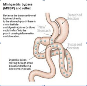 MGBP with food 300x295 - One Anastomosis Gastric Bypass (OAGB) Formerly Mini Gastric Bypass Surgery