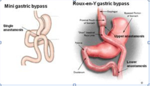 RYGBP vs MGBP 300x172 - One Anastomosis Gastric Bypass (OAGB) Formerly Mini Gastric Bypass Surgery